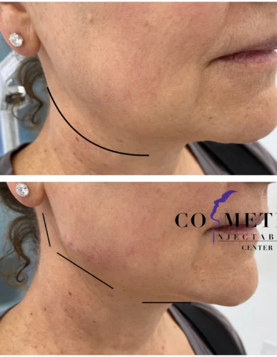 Rha 4 Jawline Filler Before And After Enhancing Jawline Definition At Sherman Oaks Medical Spa