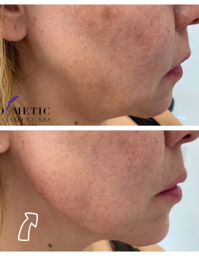 Rha 4 Dermal Filler Jawline Contouring Before And After At Sherman Oaks Medical Spa