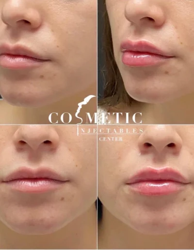 Rha 4 Lip Filler Before And After Results Enhancing Lip Shape At Sherman Oaks Medical Spa