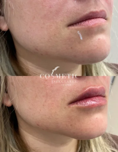 Rha 4 Dermal Filler Lip Enhancement Before And After At Sherman Oaks Medical Spa