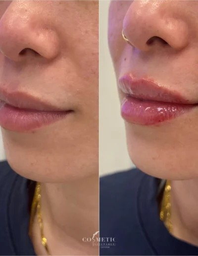 Rha 4 Lip Filler Before And After Results At Sherman Oaks Medical Spa