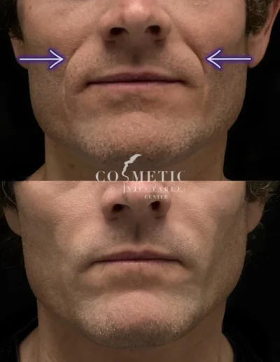 Rha 4 Dermal Filler Before And After For Nasolabial Folds At Sherman Oaks Medical Spa